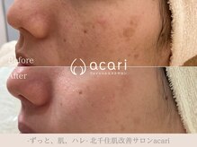 アカリ(acari)の雰囲気（結果重視の商材を使用～肌改善を目指していきます！～）