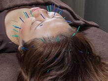 カロン(KALON)/お肌を生まれ変わらせる美肌鍼