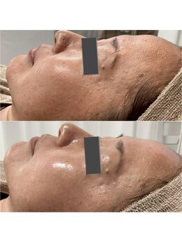 ジャスミン(Jasmin)/プラペン×幹細胞