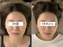 ウル 下北沢(Ulu)の雰囲気（リピート率98%！自信が持てるフェイスラインに♪#小顔#下北沢）