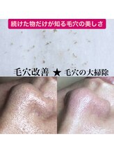 ビューティーネイル(Beauty Nail)/毛穴エクストラクション
