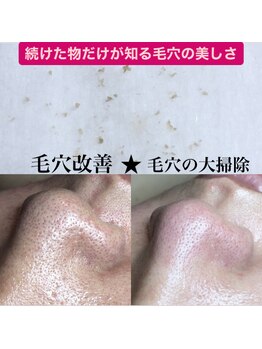 ビューティーネイル(Beauty Nail)/毛穴エクストラクション
