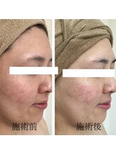 エヌミー(N me)/水素水使用の鎮静トリートメント