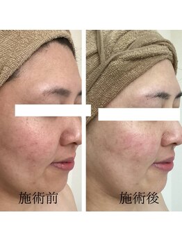 エヌミー(N me)/水素水使用の鎮静トリートメント