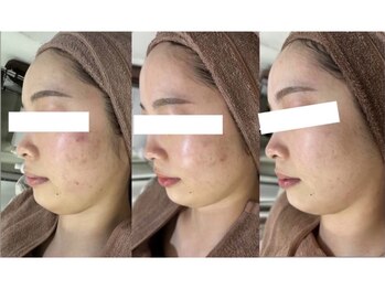 ホワイトアクア 北千住店(WHITE AQUA)/ハーブピーリング3ヶ月後の変化