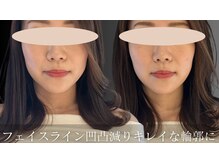 チョコバリ 中目黒店(chocobari)/小顔×リフトアップ(美容鍼)20代