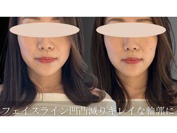 チョコバリ 中目黒店(chocobari)/小顔×リフトアップ(美容鍼)20代