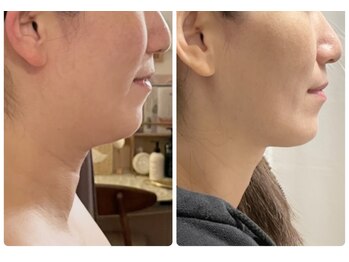 ナユラスパ(Nayula Spa)/脂肪分解レモンボトル