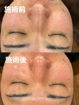 ツール(TOOL)/ハーブピーリング