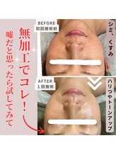 アルエット(Alouette)/ハーブピーリングbefore/after