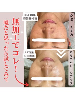 アルエット(Alouette)/ハーブピーリングbefore/after