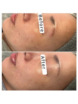 エヌプラス(N+)/40代女性＊ピーリング2回後(2)