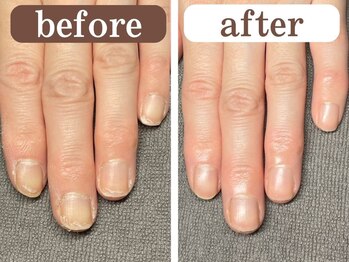 二枚爪でお悩みのお客様