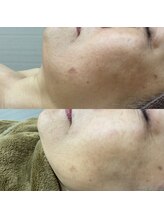 ギャラクシービューティー(galaxy beauty)/IPLフォトでシミケア☆