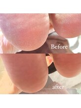 メリーミー(Merry me)/フット角質ケア　