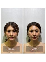 シャルム(CHARMEB)/フェイスラインをスッキリしたい