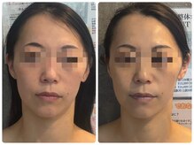 さとう美容整体 町田店/フェイシャルハイパーナイフ2回