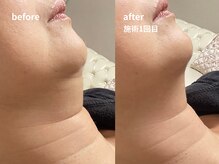 アキ/1回の施術効果！二重アゴ集中