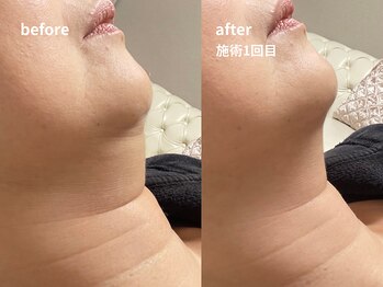 アキ/1回の施術効果!二重アゴ集中