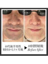 エリクサー 加須店(Elixir)/10回の照射後before after