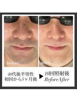 エリクサー 加須店(Elixir)/10回の照射後before after