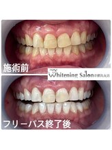 ホワイトニングサロン 京都烏丸店/ホワイトニング施術例