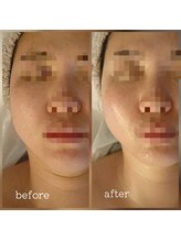 カルナボディ(Carna body.)/二十顎、たるみケアで若見え☆