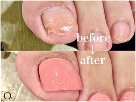 フットネイル★深爪矯正