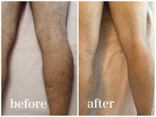 メンズサバス たまプラーザ/メンズ足脱毛/5回