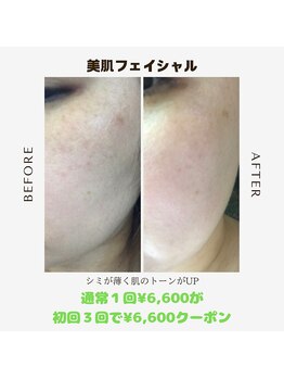 バグジーエピ(BAGZY EPI)/美肌フェイシャル☆彡