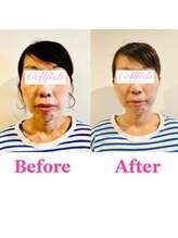 セルフィッシュ(Cellfish)/小顔矯正