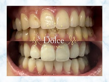 ドルチェ(Dolce)/ビフォーアフター