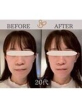 チョコバリ 錦糸町店(chocobari)/小顔×リフトアップ(美容鍼)20代