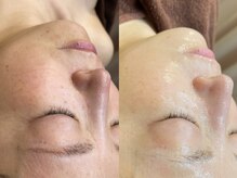 レシェルサロン(Lechelle Salon)/ダーマエステ幹細胞フェイシャル