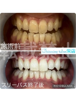 ホワイトニングサロン 名古屋 栄店/【ホワイトニング】