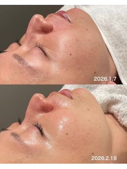 アイビーケア 三田(ivy care)の写真/【40代からの艶肌ピーリング】剥離なしの肌育ピーリングでほうれい線・シワ・たるみ・毛穴開きを集中ケア。