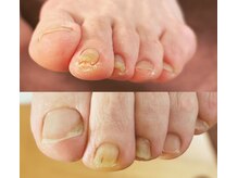 アベビー(Abeby)/爪周りのケア