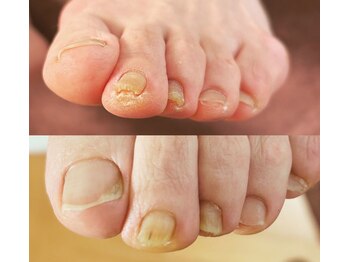 アベビー(Abeby)/爪周りのケア