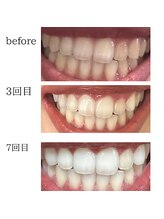 ホワイトニングショップ 山形店(Whiteningshop)/スタッフの歯の変化（山形店）