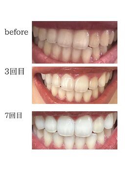 ホワイトニングショップ 山形店(Whiteningshop)/スタッフの歯の変化（山形店）