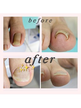 巻き爪補正店 大阪なんば店/巻き爪補正　2箇所