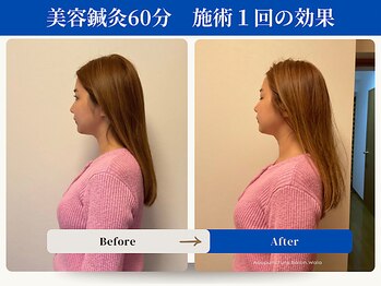 和ら/全身鍼灸60分/巻肩/姿勢改善