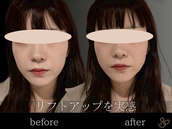 チョコバリ 郡山店(chocobari)/小顔×リフトアップ(美容鍼)20代