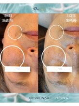 ポノ(Pono)/三回施術のお客様☆