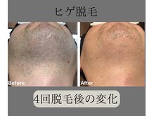 グロワール(gloire)/ヒゲ脱毛BeforeAfter