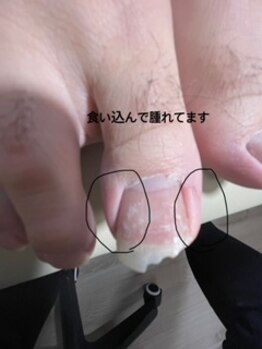 サロン こころ/巻いた爪