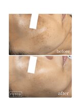 リレア(Riyrea)/New!最新連射式光フェイシャル