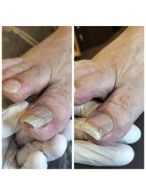 立川巻爪補正院/巻き爪　初回の術前・術後