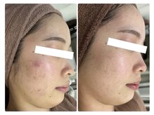 ホワイトアクア 北千住店(WHITE AQUA)/ハーブピーリング/肌質改善/毛穴