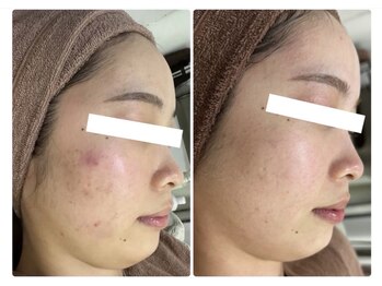 ホワイトアクア 北千住店(WHITE AQUA)/ハーブピーリング/肌質改善/毛穴